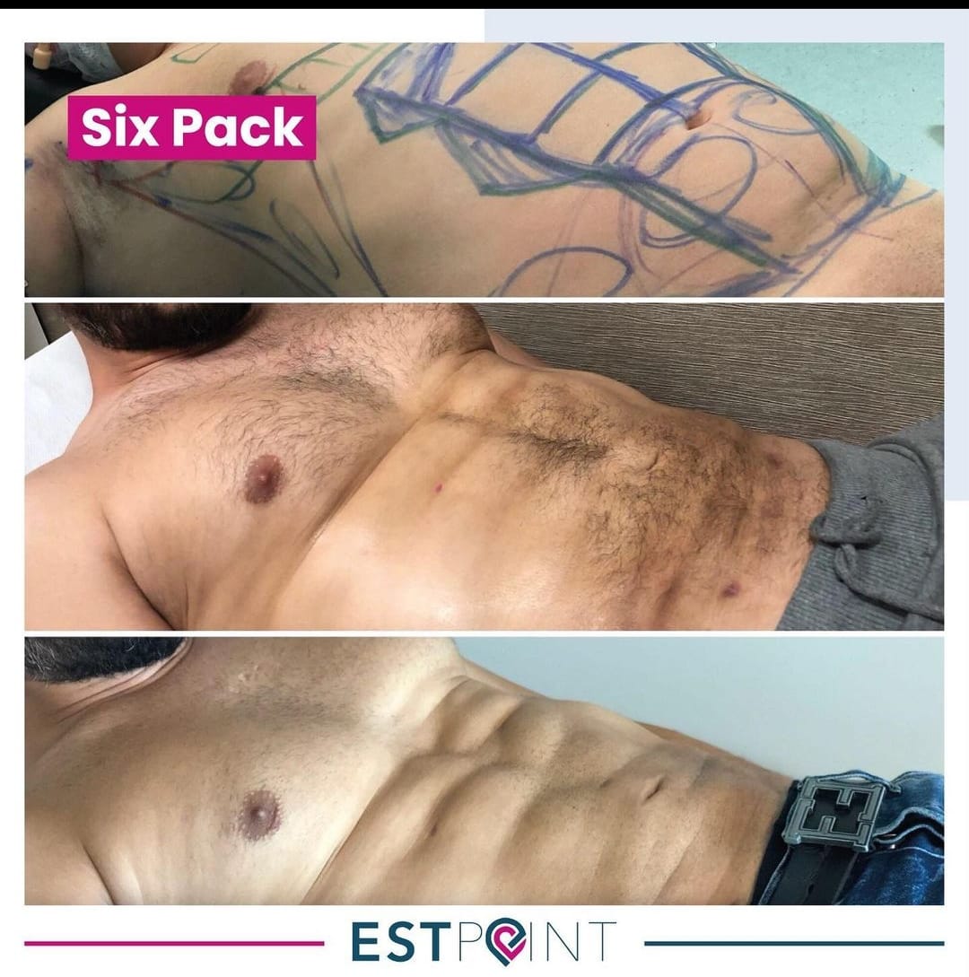 Six Pack Öncesi Sonrası