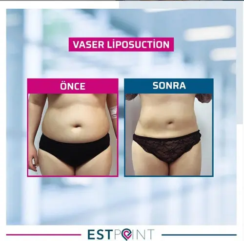 Liposuction Öncesi Sonrası