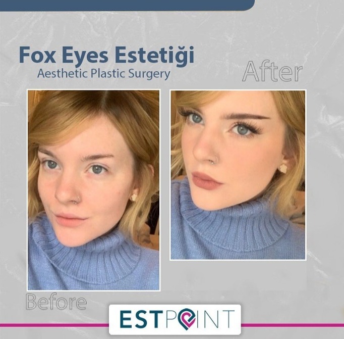 Fox Eyes Estetiği Öncesi Sonrası